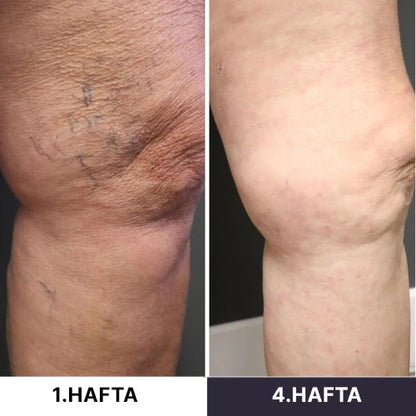 Seravive™ - Mikro Dolaşım Terapisi