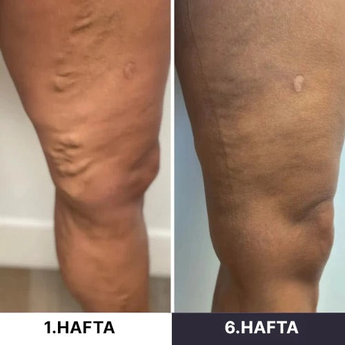 Seravive™ - Mikro Dolaşım Terapisi