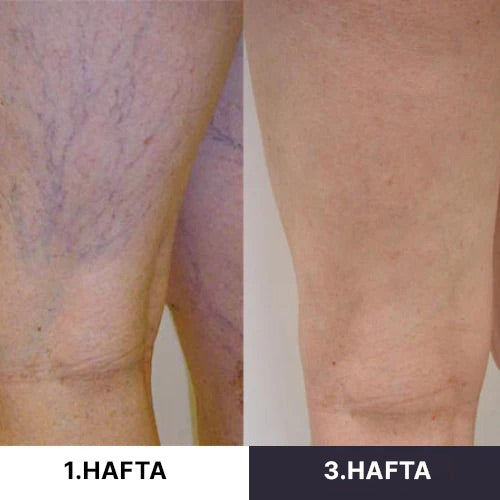 Seravive™ - Mikro Dolaşım Terapisi