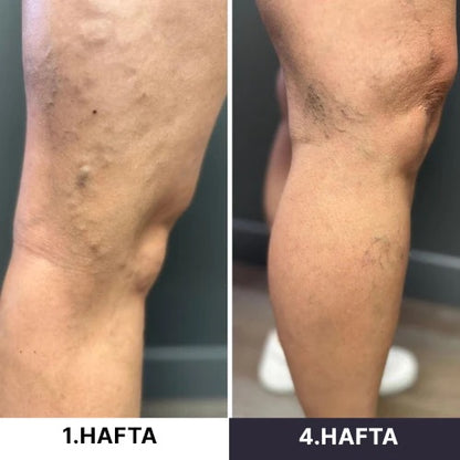 Seravive™ - Mikro Dolaşım Terapisi